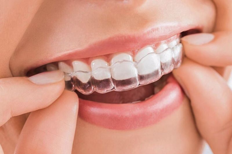 Niềng răng trong suốt là phương pháp thường được chọn