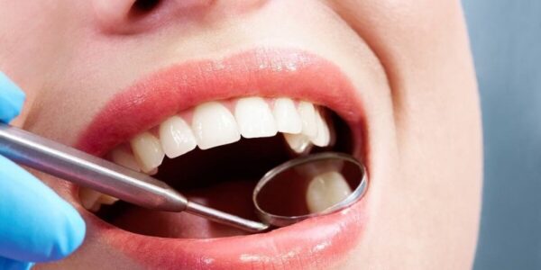 Quy trình bọc răng sứ cho răng sâu như thế nào ?