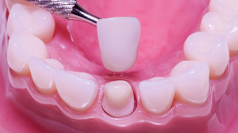 Bọc răng sứ cho răng sâu có đau không?