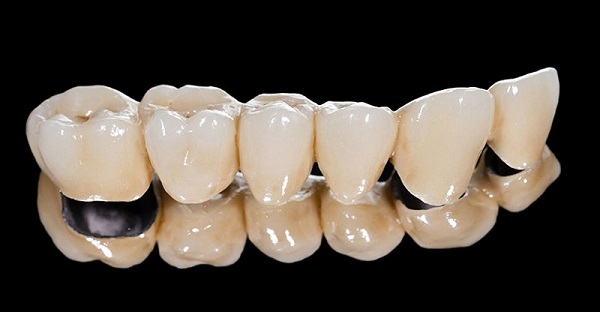 Răng sứ kim loại có độ bền cao 