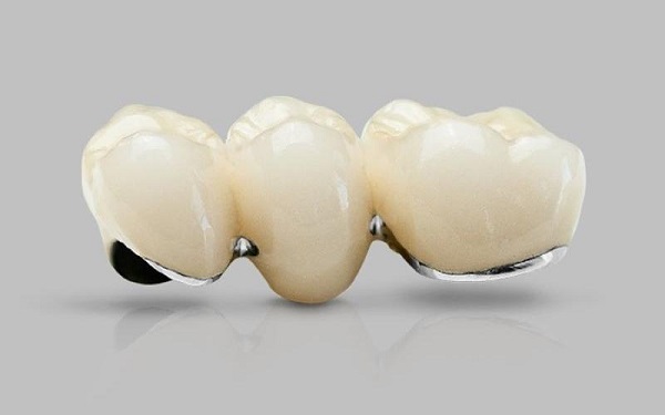 Răng sứ kim loại thường có giá thành phải chăng 