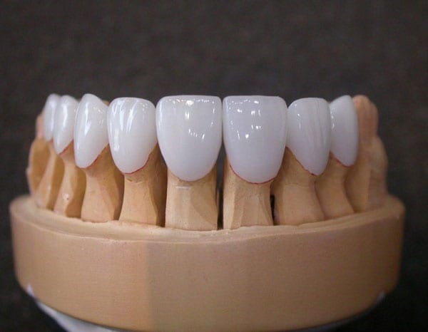Răng sứ Titan có trọng lượng nhẹ hơn so với răng sứ kim loại thường 