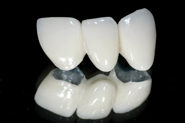 Răng sứ kim loại có tốt không? Tác hại của răng sứ kim loại