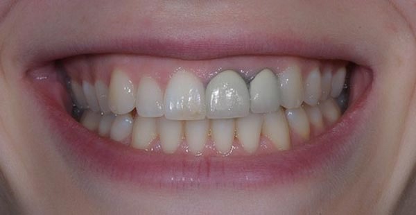 Phương pháp bọc răng sứ titan có bị đen không? Tại sao răng sứ loại titan lâu ngày bị đen?