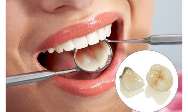 Bọc răng sứ titan có bị đen không? Cần lưu ý những gì?