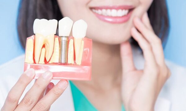 Trồng răng implant có vĩnh viễn không? Cần lưu ý những gì?