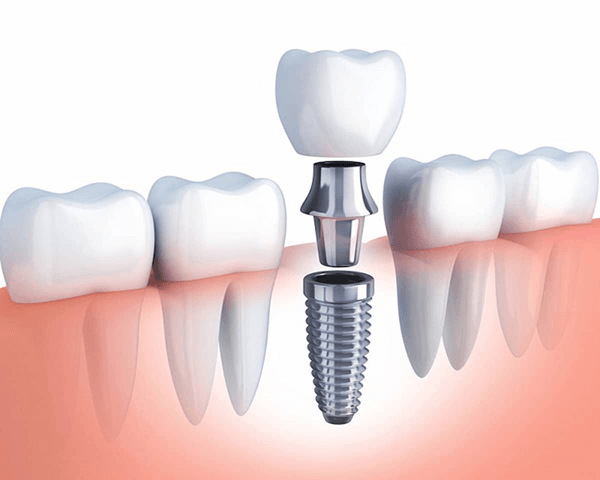 An toàn, không đau với công nghệ trồng răng implant