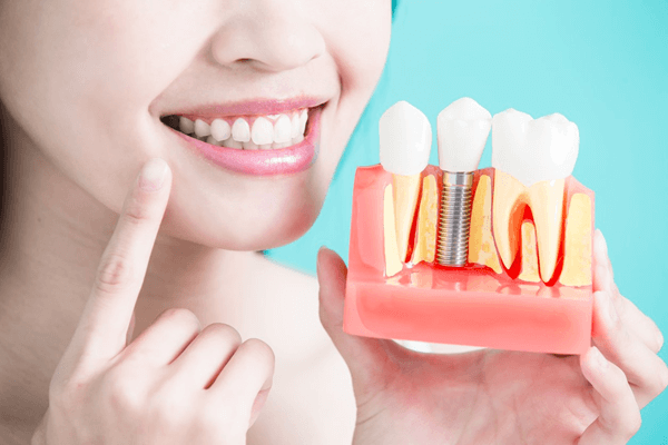 Công nghệ trồng răng implant có điều trị thời gian ngắn