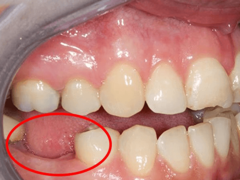 Mất răng lâu năm ảnh hưởng dây thần kinh