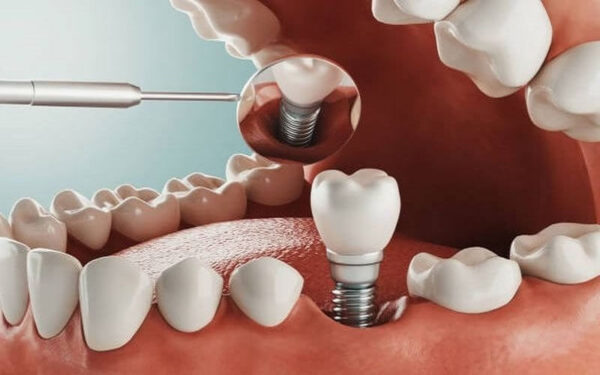 Lưu ý cần biết khi trồng răng implant đối với người bệnh tiểu đường.