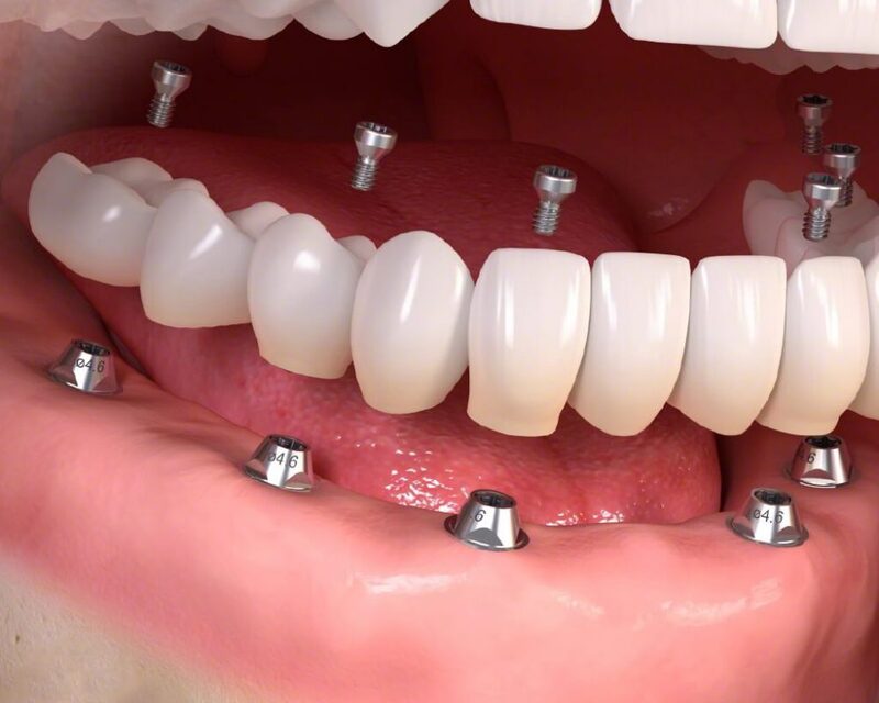 Thành công và thất bại với các nghiên cứu khi người tiểu đường trồng răng Implant