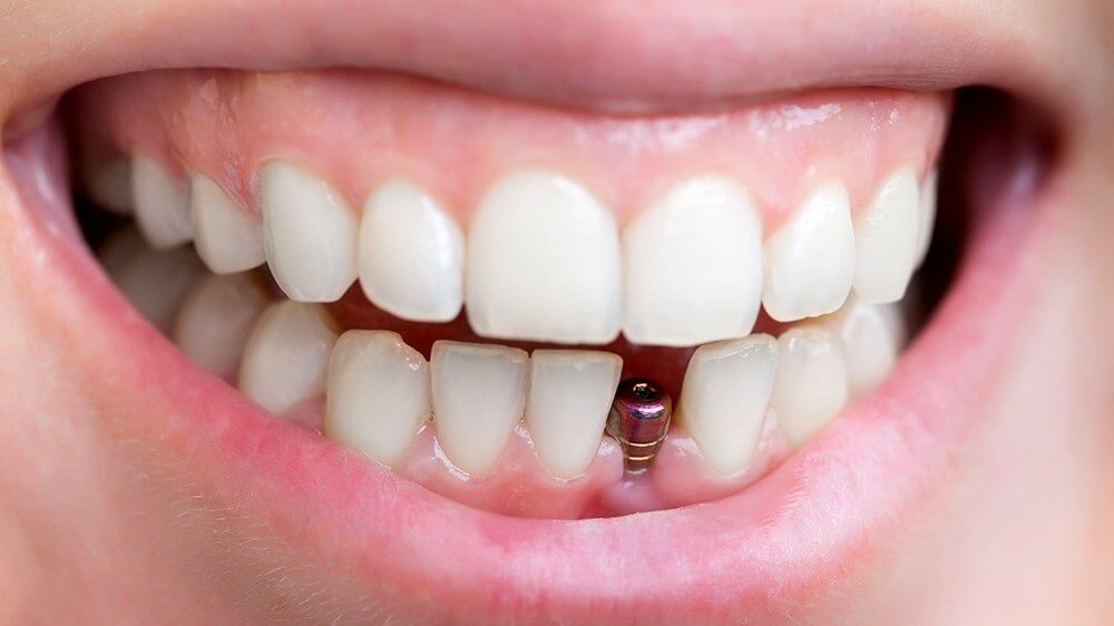 Thông thường bác sĩ chuyên khoa sẽ đưa ra khoảng thời gian chỉ định trồng implant sau nhổ răng