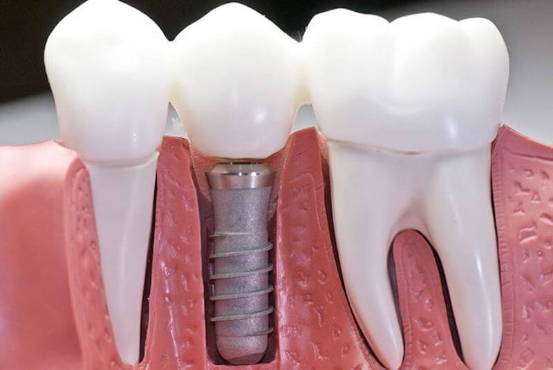 Trồng răng implant hoàn toàn không bị cảnh báo an ninh khi qua cổng an ninh.
