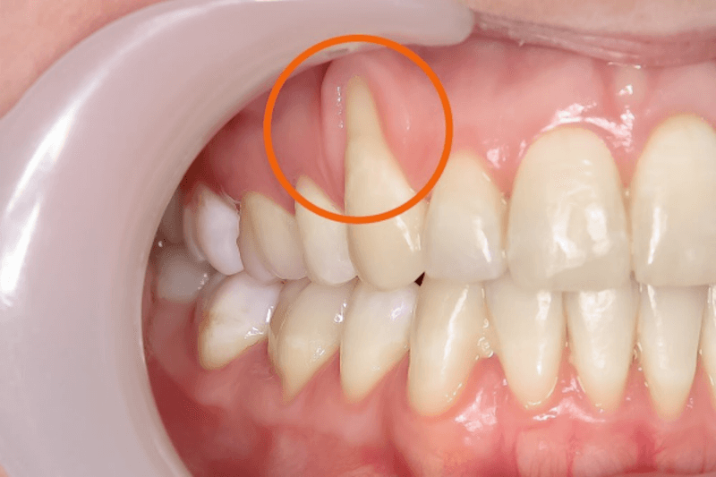 Niềng răng bị bật chân răng và cách xử lý.