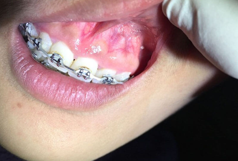 Dấu hiệu nhận biết bị bật chân răng khi niềng răng.