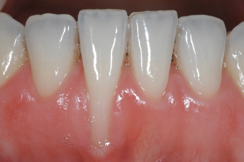 Chăm sóc răng miệng sai cách dễ dẫn đến bật chân răng khi đang niềng.