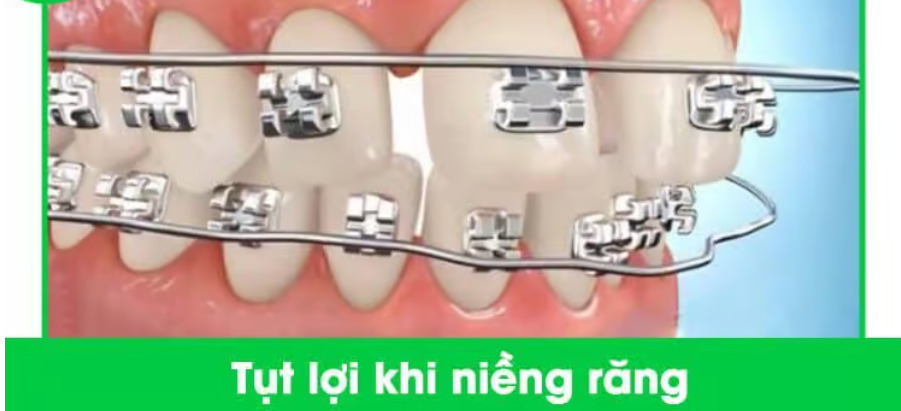 Có nhiều nguyên nhân khiến việc niềng răng bị tụt lợi