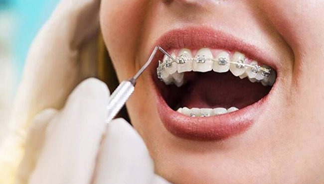 Dựa vào mức độ nặng của tình trạng niềng răng bị tụt lợi để điều trị phù hợp