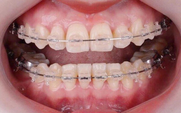 Niềng răng bị tụt lợi là như thế nào? Nguyên nhân và cách khắc phục