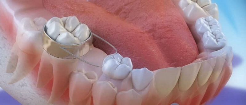 Các nguyên nhân gây ra tình trạng mất răng ở trẻ