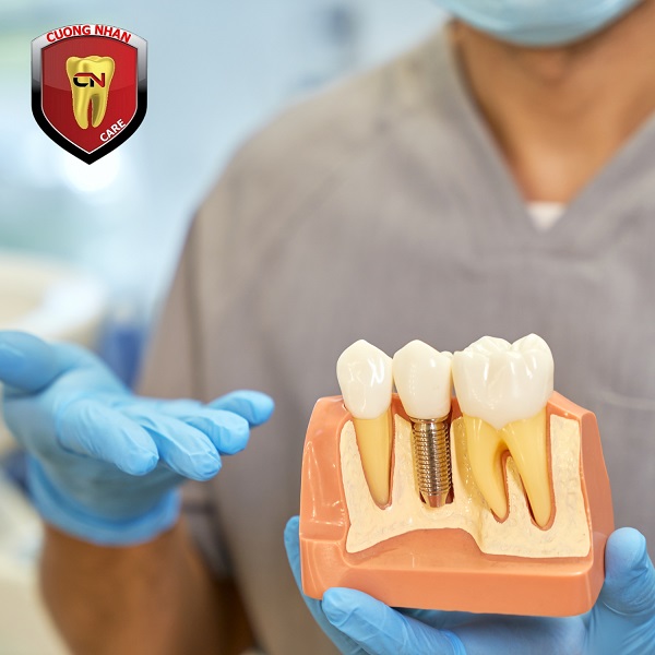 Cách khắc phục trồng răng Implant bị lung lay nhanh và an toàn