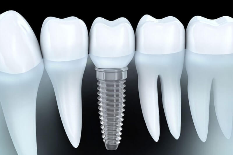 Tổng quan về trồng răng Implant