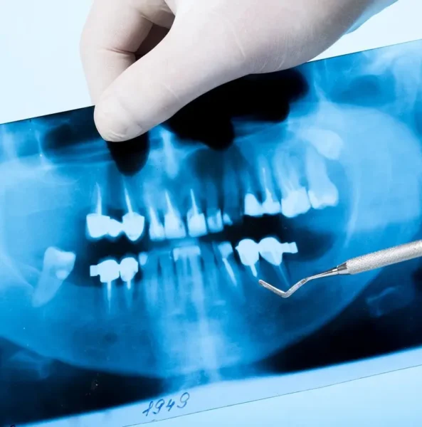 Giải đáp: Trồng răng implant có chụp X quang được không?