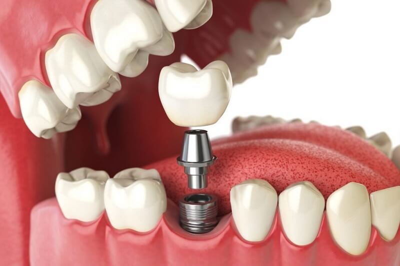 Trồng răng implant hoàn toàn có thể chụp X-quang