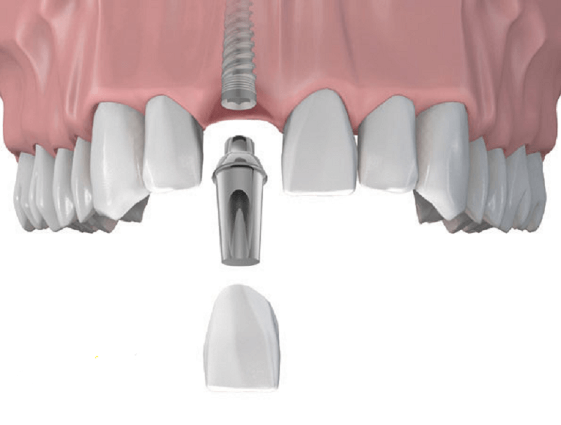 Trồng răng implant răng cửa giúp phục hình những chiếc răng bị mất 