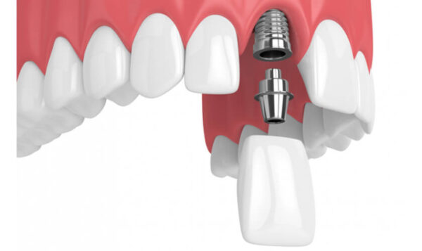 Trồng răng implant răng cửa: Những lưu ý quan trọng