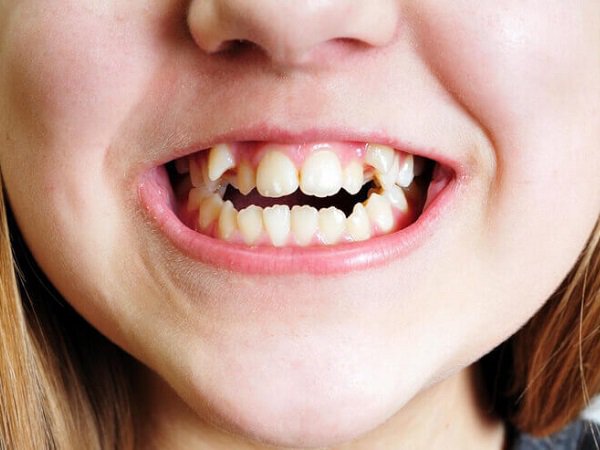 Có nhiều nguyên nhân khiến răng trẻ bị xô lệch, không đều 