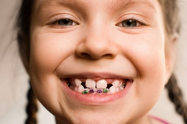 Niềng răng từ sớm giúp bác sĩ nha khoa dễ dàng kiểm soát và khắc phục các vấn đề về răng