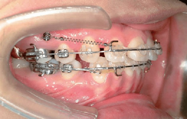 Lò xo niềng răng loại đẩy để nới rộng khoảng trống giữa các răng