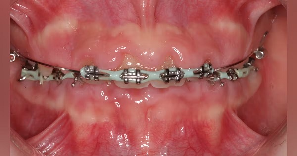 Lợi trùm khi niềng răng là tình trạng như thế nào?