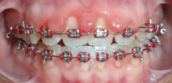 Lợi trùm khi niềng răng là gì? Nguyên nhân gây lợi trùm