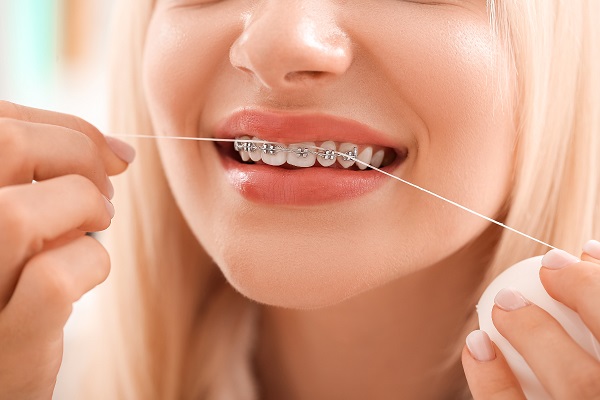 Khắc phục lợi trùm khi niềng răng an toàn, đơn giản và hiệu quả