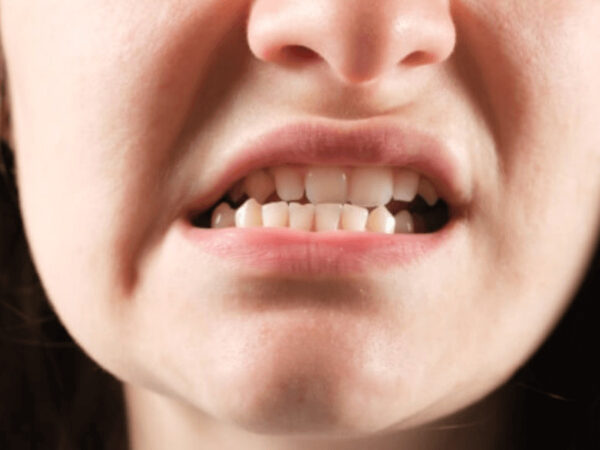 Phương pháp niềng răng lệch khớp cắn phổ biến nhất hiện nay