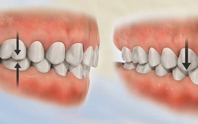 Lắp răng sứ sai lệch cũng gây hiện tượng đau và ê buốt.