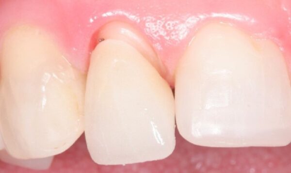 Dấu hiệu răng sứ bị hở - Nên xử lý như thế nào an toàn nhất?