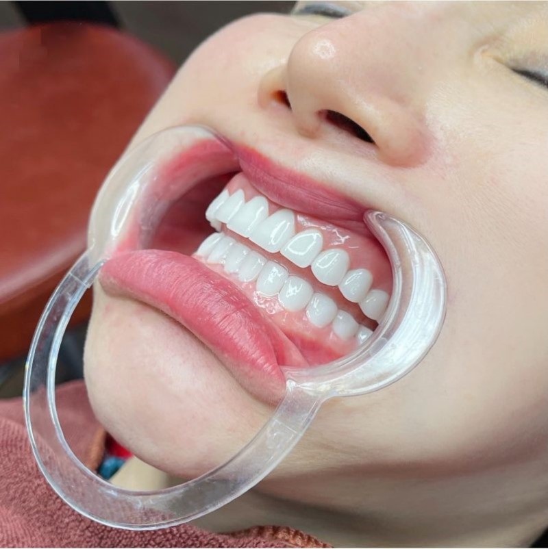 Bọc răng sứ bị hở có tác hại gì?