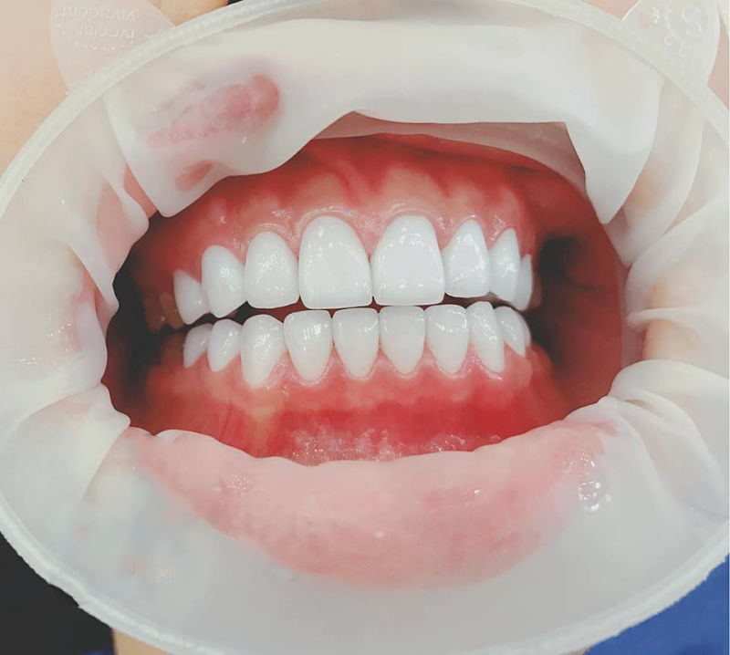 Xử lý răng sứ bị hở như thế nào an toàn nhất?