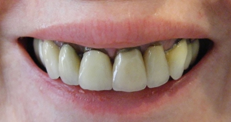 Nguyên nhân khiến bọc răng sứ bị đen chân răng?