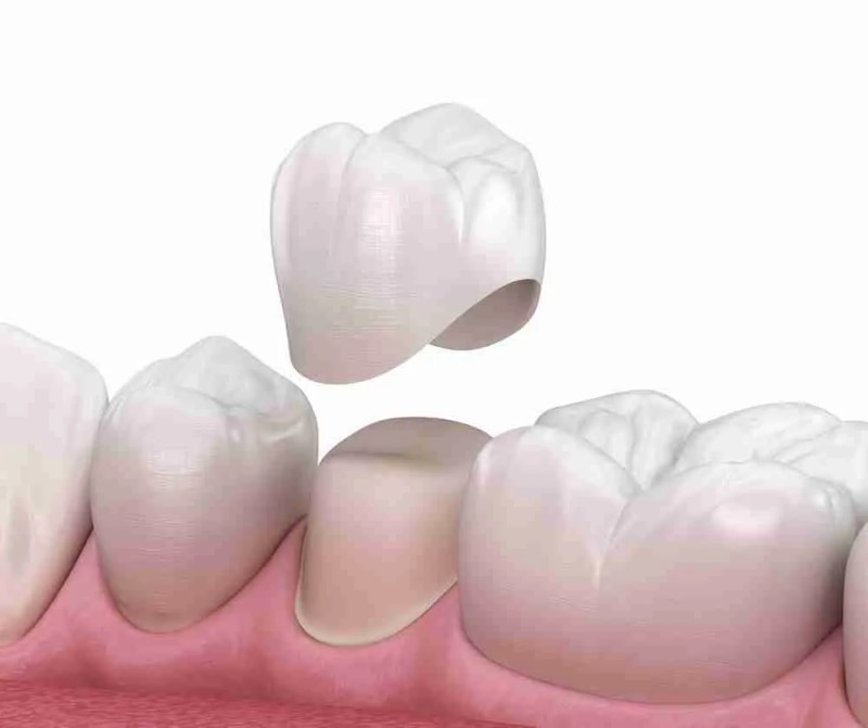 Vì sao bọc răng sứ bị hỏng?