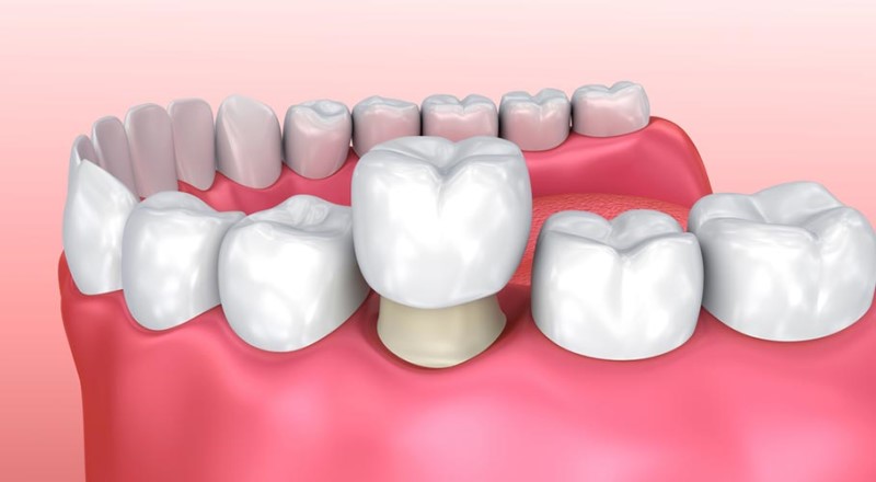 Một số trường hợp răng sứ bị hỏng sau bọc