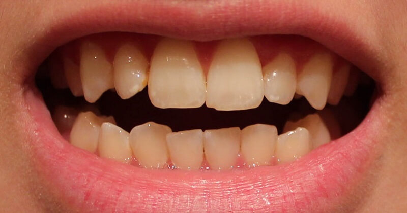 Nguyên nhân nào làm cho răng sứ bị xỉn màu?