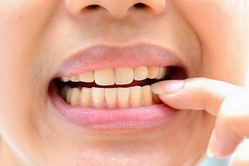 Bọc sứ kém chất lượng có thể khiến răng sứ gặp tình trạng ố vàng, xỉn màu.
