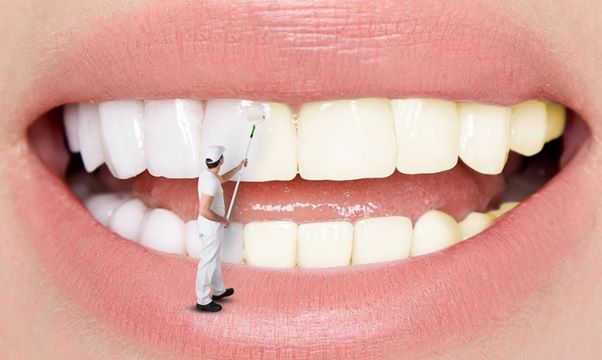 Các cách làm tẩy trắng răng sứ hiệu quả