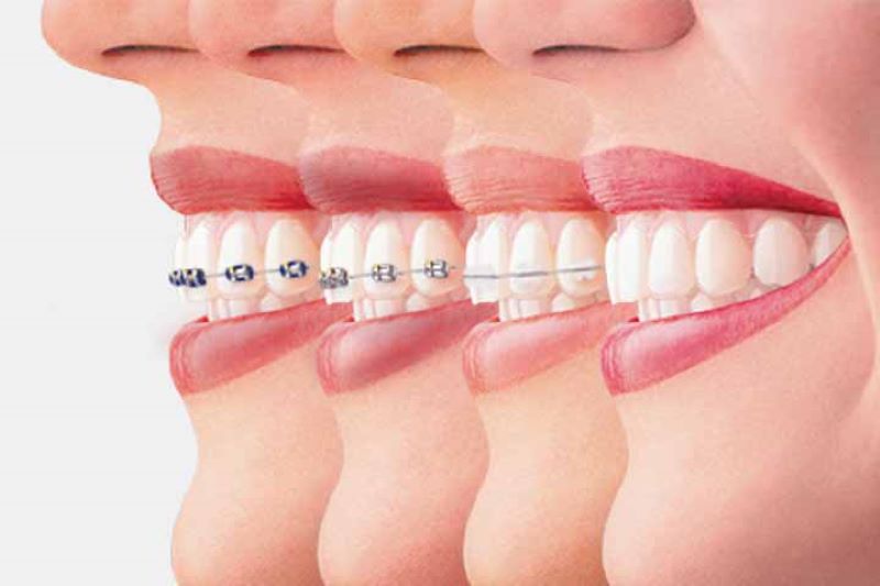 Làm răng sứ có niềng răng được không?