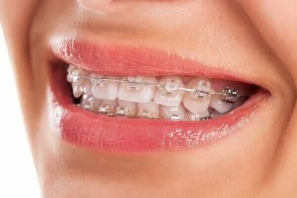 Giải đáp - Làm răng sứ có niềng răng được không?