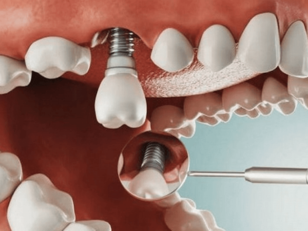 Cấy răng Implant có ảnh hưởng gì không?  